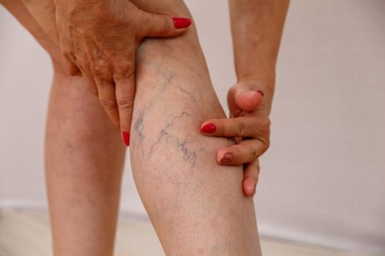 Different Types of Vein Conditions Everyone Should Be Aware Of