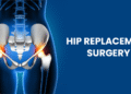 hip replacement surgery