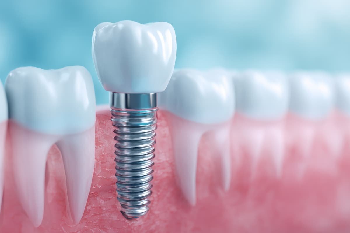 Restoring Oral Health and Confidence with Modern Dental Implant Solutions 1 Restoring Oral Health and Confidence with Modern Dental Implant Solutions