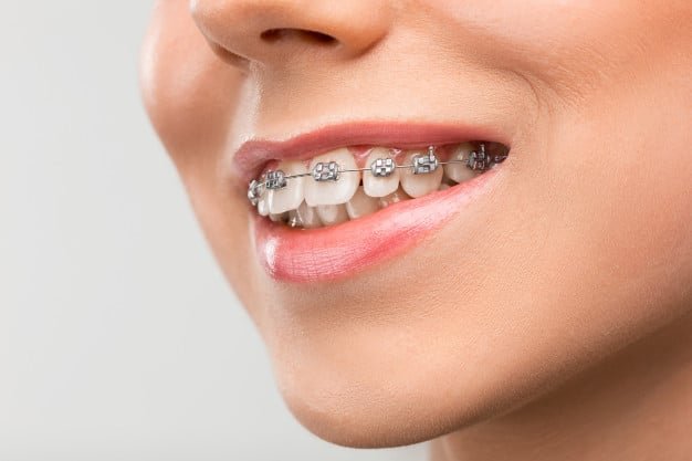 What Types of Dental Braces Are Available in Singapore? 1 What Types of Dental Braces Are Available in Singapore?